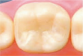 ダイレクトボンディング