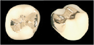 ゴールドインレー／アンレー