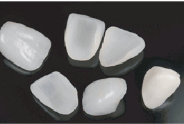 ラミネートべニア