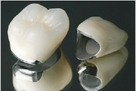 メタルボンド